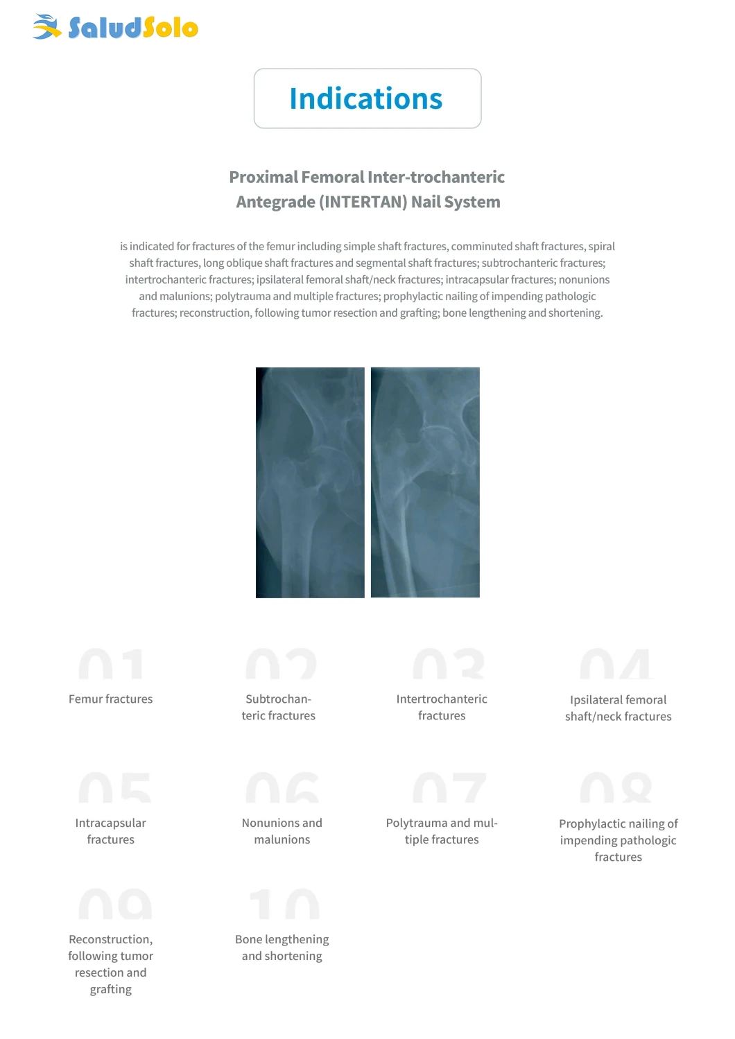 Orthopedic Surgical Implant for Trauma Surgery, Standard Proximal Femoral Intertrochanteric Antegrade Nails, Intertan Intramedullary Nail System